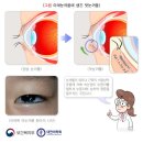 안검하수, 안검내반 등을 치료하기 위한 시력개선 목적의 이중검수술은 보상[실손의료비보험 2016년 1월 이후 ] 이미지