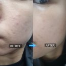 골드 | 화농성여드름 치료 골드PTT 후기! 재발성 여드름 고민이라면
