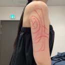 경주사 | 성남 팔뚝 지방추출주사 달스주사 당일 통증부터 효과 붓기 멍 후기