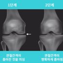 설담한의원 | [천안한의원]퇴행성 관절염 자가진단 하는 방법!