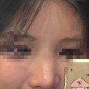 11650-7-10-4 | 10년된 코수술 전체제거 2탄 (feat. 수술과정후기/7개월차 경과)