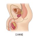 고환염 (Orchitis)이란? 이미지