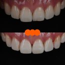 치과미학치과의원 | 강남치과 짧아 보이는 치아 레진으로 당일 치료