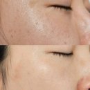 춘천기미케어 추천 가평피부관리 윤이나다 색소케어 후기