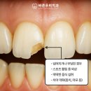 미소안e바른치과의원 | 사수동치과 앞니 파절 어떻게 치료할까요?