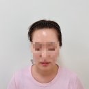 제이앤케이(J&K) 뷰티라인 | 홍대두피문신 제이플릿홍대본점에서 헤어라인 SMP 받은 리얼 후기