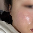 부광사우나 | 광주 내돈내산 리쥬란 1회차