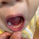 [세곡달빛의원] 1세 아이 추석 연휴 중 수족구 증상으로 긴급 방문기(달빛의원 주변 소개포함)