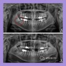 옥산치과의원 | 양산사랑니치과 ｜ 드라이소켓 증상 후기 알려드릴게요