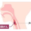 작은후두암 티스토리