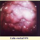 4. 혈관기형(Vascular Malformation)③정맥성 기형 이미지