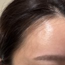 진상의원 | 왕십리 밴스의원 주름 보톡스 솔직후기｜이마·미간 보톡스 효과