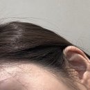 얼굴 전체 10만 원대 편평사마귀 제거 레이저 후기, 병원 추천