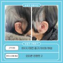 금산-51 | 금산보청기,이XX고객님 오티콘 인텐트 2 구매후기(80대, 女)