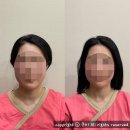 성인두상교정 수술없이 일산 순수본교정으로 안면비대칭 관리(나는 어떤 비대칭 유형일까)