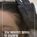강남헤어라인 후기 M자탈모 자연스럽게 채운 리얼후기