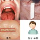 쇼그렌 증후군[Sjogren&#39;s syndrome] 이미지