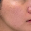 차스킨 - 수원시 권선구 하탑로30번길 27 | 신사역피부과 리투오 스킨부스터 후기 / 일주일차 효과, 가격