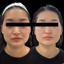 뷰티콜라겐대구지사 | 대구 피부관리 아미뷰티센터 심부볼 리프팅 잘하는 피부샵