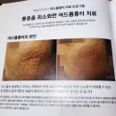 목동 한의원에서 여드름흉터 치료 3회차 후기