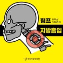 버팔로 | 버팔로 험프 지방흡입 후기, 결과 차이 나는 이유