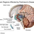 파킨슨 치료에 획기적 발견 이미지