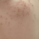 압구정약국 | 압구정 피부과에서 기미레이저 받은 한달 후기+가격!!(재업)