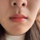 미희뷰티 | 팔자주름 고민으로 다녀온 대구피부과 미희주사 후기