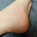 매일봄약국 | 약국 우레아 크림 쓸때 이거모르면 효과못봄ㅠ(필독!)