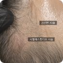 [군자 헤어라인 문신] 퍼스널 smp 시술맛집, 사월에 스튜디오