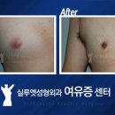 19세 여유증 수술 이미지