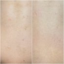 영등포세무서 내 | [서울/영등포] 등드름 전문 “솔에스테틱 영등포점”에서 바디리셋솔루션케어 받은 찐 후기