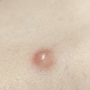 (유)대한환경 | 어깨 표피낭종 제거 수술 후기 : 삼성서울유외과. 비용. 수술. 주차. 낭종 사진 포함. 혐주의.