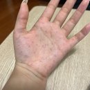 세란의원 | 세란통마취통증의학과의원 다한증 보톡스 후기(주차,실비)
