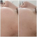 [광주 첨단 피부관리] The 특별한날 보톡스미백리프팅관리 솔직후기