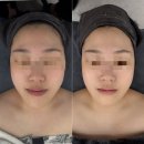 움트다 에스테틱 | 직장인 리프팅 관리 추천｜움트다 에스테틱 하이푸 3000샷 내돈내산 후기 (턱선 변화 있음)