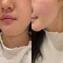 올부자 | 신사 올타이트리프팅 바디리프팅 이중턱 부자 효과 가격 후기