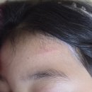 포항라온성형외과의원 | 포항 봉합수술 어린이 얼굴 이마 찢어짐 라온성형외과