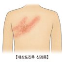 ﻿﻿수두-대상포진(Herpes Zoster) 질병의 원인,증상,진단,합병증,치료 이미지