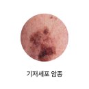 기저세포 암종(Basal cell carcinoma)종양혈액질환, 피부질환이란? 이미지