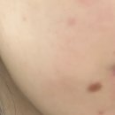 신나는의원 | ㅂㄷㅂ의원 잡티 루비레이저 내돈내산 찐후기