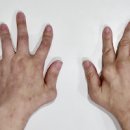 손가락 관절염 류마티스 관절염 (류머티스) 이미지
