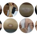 <피부칼럼> 상처, 흉터, 화상, 착색,태선화된 피부 침치료로 호전시키다!