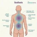 카이로프랙틱에서 이해하는 척추측만증 Scoliosis · 이미지