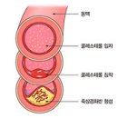 고지혈증이란 이미지