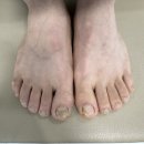 검단 내성발톱 무좀치료 못생긴 발톱 탈출한 후기