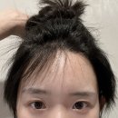 광화로 12-11 ~ 광화로 12-9 사이 | 압구정모발이식 여자 헤어라인 3,800모 9개월~12개월(1년차) 솔직후기