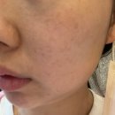 킴스의원 | [하단 피부과] 킴스뷰티의원 기미색소 치료후기 (상담편)