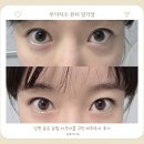 인천 송도 눈밑 다크서클 고민 미희주사 후기