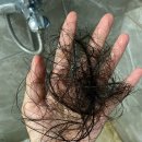 바르는 미녹시딜 여자 탈모 효과 부작용 쉐딩 현상 후기